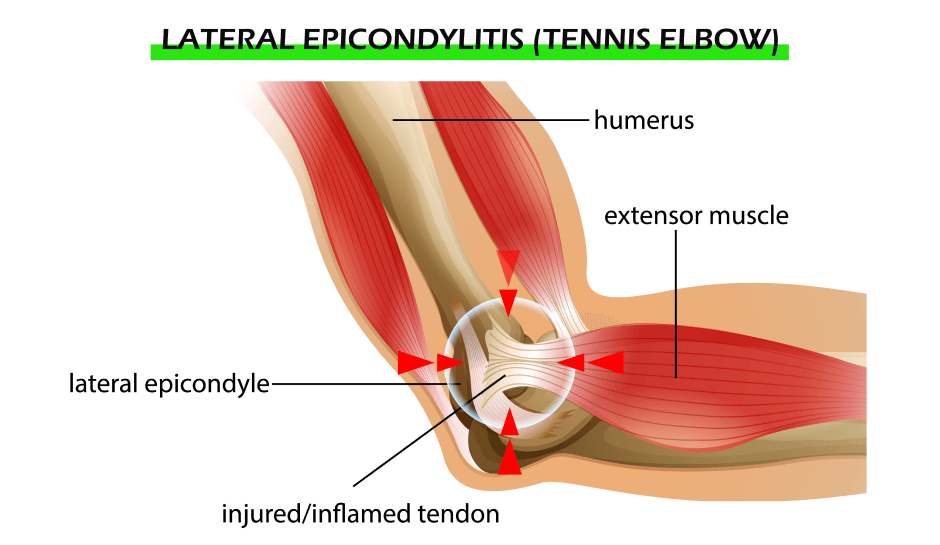 Causes and Symptoms of Tennis Elbow